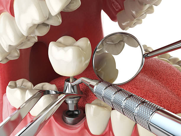 Best Emergency Treatment for Dental Infections or Abscesses in Rogersville, TN